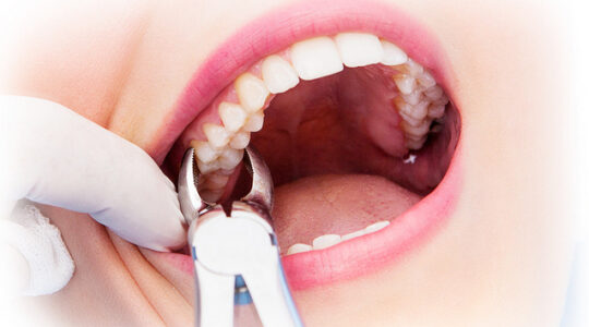 Коли ріжуться зуби мудрості?