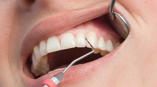 Вініри для зубів: очікування та результат