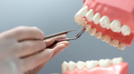 Скільки служить зубний імплант